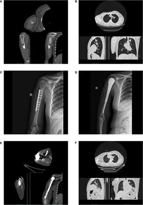 Case report: A balance of survival and quality of life in long-term survival case of lung adenocarcinoma with synchronous bone metastasis